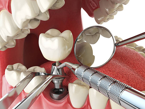 Best Emergency Wisdom Teeth Removal in Wekiwa Springs, FL